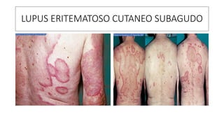 LUPUS ERITEMATOSO CUTANEO SUBAGUDO
 
