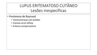 LUPUS ERITEMATOSO CUTÂNEO
Lesões inespecíficas
• Fenómeno de Raynaud
• Vasoconstriçao com palidez
• Cianose acral reflexa
• Eritema compensatório
 