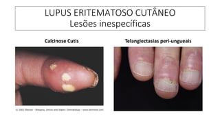LUPUS ERITEMATOSO CUTÂNEO
Lesões inespecíficas
Calcinose Cutis Telangiectasias peri-ungueais
 
