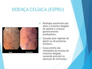 DOENÇA CELÍACA (ESPRU)
 Patologia autoimune que
afeta o intestino delgado
de adultos e crianças
geneticamente
predispostos.
 Causada pela ingestão de
glúten ou de proteínas
similares.
 Causa atrofia das
vilosidades da mucosa do
intestino delgado,
causando prejuízo na
absorção de nutrientes.
 