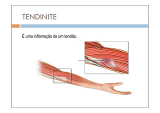 TENDINITE

É uma inflamação de um tendão.
 