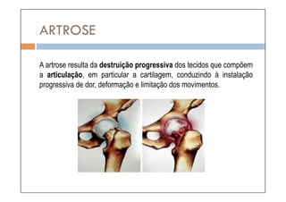 ARTROSE

A artrose resulta da destruição progressiva dos tecidos que compõem
a articulação, em particular a cartilagem, conduzindo à instalação
progressiva de dor, deformação e limitação dos movimentos.
 