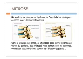ARTROSE
Na ausência de parte ou da totalidade da "almofada" da cartilagem,
os ossos roçam directamente entre si.




Com a evolução no tempo, a articulação pode sofrer deformação
visível ou palpável, cuja tradução mais comum são os osteofitos,
conhecidos popularmente na coluna, por " bicos de papagaio “.
 
