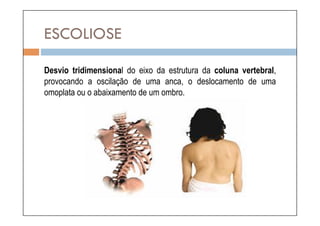 ESCOLIOSE

Desvio tridimensional do eixo da estrutura da coluna vertebral,
provocando a oscilação de uma anca, o deslocamento de uma
omoplata ou o abaixamento de um ombro.
 