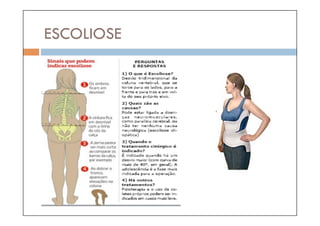 ESCOLIOSE
 