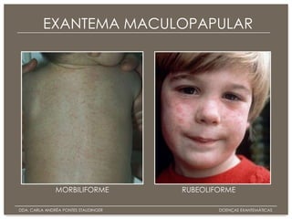 Doenças+exantemática | PPTX