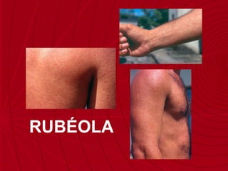 SARAMPO RUBÉOLA 