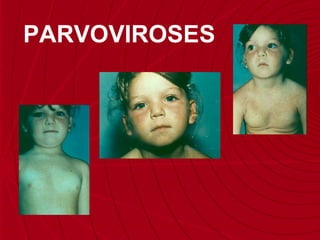 SARAMPO PARVOVIROSES 