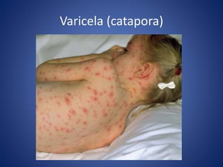 Varicela (catapora)
 