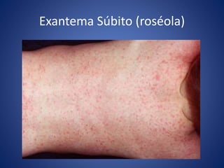 Exantema Súbito (roséola)
 