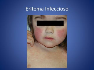 Eritema Infeccioso
 