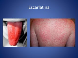 Escarlatina
 