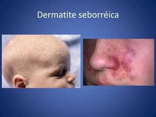 Dermatite seborréica
 