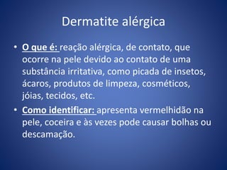 Dermatite alérgica
• O que é: reação alérgica, de contato, que
ocorre na pele devido ao contato de uma
substância irritativa, como picada de insetos,
ácaros, produtos de limpeza, cosméticos,
jóias, tecidos, etc.
• Como identificar: apresenta vermelhidão na
pele, coceira e às vezes pode causar bolhas ou
descamação.
 