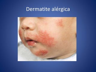 Dermatite alérgica
 