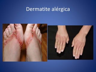 Dermatite alérgica
 