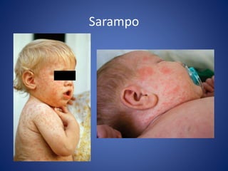 Sarampo
 