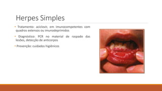 Herpes Simples
• Tratamento: aciclovir, em imunocompetentes com
quadros extensos ou imunodeprimidos
• Diagnóstico: PCR no material de raspado das
lesões, detecção de anticorpos
• Prevenção: cuidados higiênicos
 