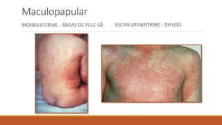 Maculopapular
MORBILIFORME - ÁREAS DE PELE SÃ ESCARLATINIFORME - DIFUSO
 