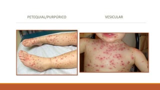 PETEQUIAL/PURPÚRICO VESICULAR
 