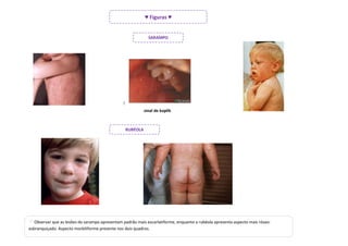 ♥ Figuras ♥


                                                                SARAMPO




                                                ]

                                                              sinal de koplik



                                                    RUBÉOLA




   Observar que as lesões do sarampo apresentam padrão mais escarlatiforme, enquanto a rubéola apresenta aspecto mais róseo-
esbranquiçado. Aspecto morbiliforme presente nos dois quadros.
 