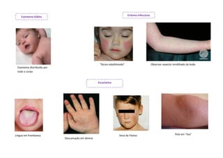 Eritema Infeccioso
    Exantema Súbito




                                                    “fácies esbofeteada”                        Observar aspecto rendilhado da lesão
 Exantema distribuído por
 todo o corpo


                                                   Escarlatina




Língua em framboesa                                                Sinal de Filatov                                Pele em “lixa”
                            Descamação em lâmina
 