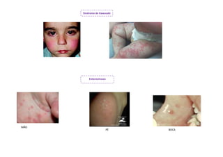 Síndrome de Kawasaki




          Enteroviroses




MÃO
                      PÉ     BOCA
 