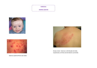 VARICELA

                                   HERPES-ZÓSTER




                                                   Herpes-zóster: observar a distribuição da lesão,
                                                   respeitando os limites do dermátomo acometido

Observar pleomorfismo das lesões
 