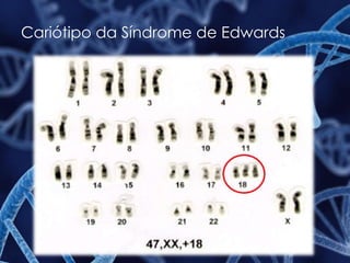 Cariótipo da Síndrome de Edwards
 