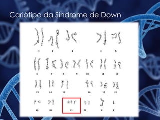 Cariótipo da Síndrome de Down
 