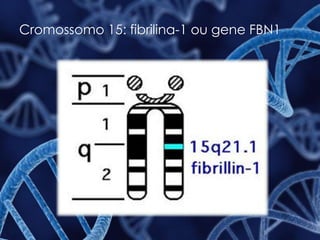 Cromossomo 15: fibrilina-1 ou gene FBN1
 