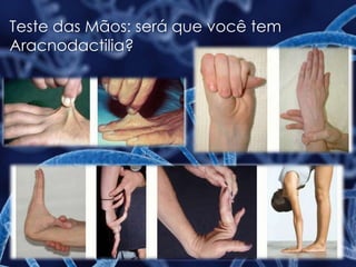 Teste das Mãos: será que você tem
Aracnodactilia?
 