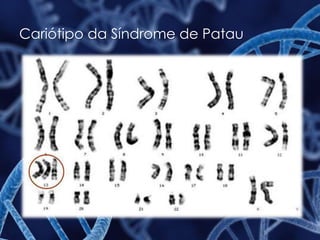 Cariótipo da Síndrome de Patau
 