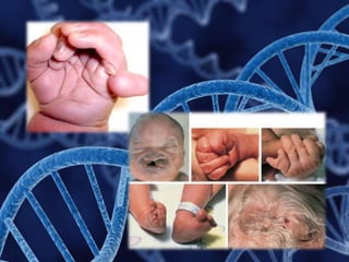 Doenças genéticas: Síndromes