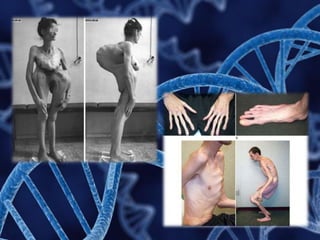 Doenças genéticas: Síndromes