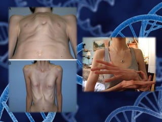 Doenças genéticas: Síndromes