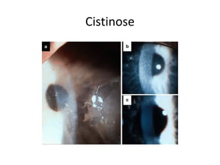 Cistinose
 