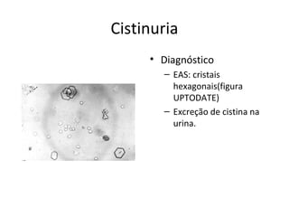 Cistinuria
• Diagnóstico
– EAS: cristais
hexagonais(figura
UPTODATE)
– Excreção de cistina na
urina.
 