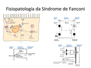 Fisiopatologia da Síndrome de Fanconi
 