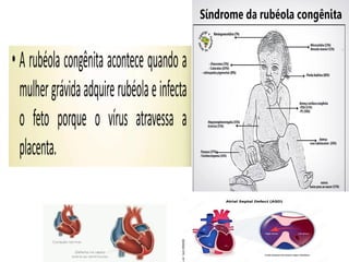 Doenças Imunopreveníveis na Infância e Imunização.ppt