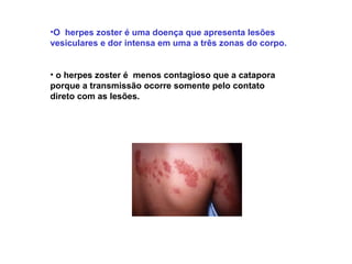 •O herpes zoster é uma doença que apresenta lesões
vesiculares e dor intensa em uma a três zonas do corpo.
• o herpes zoster é menos contagioso que a catapora
porque a transmissão ocorre somente pelo contato
direto com as lesões.
 