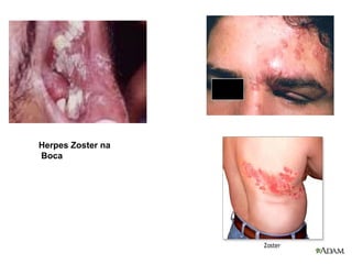Herpes Zoster na
Boca
 