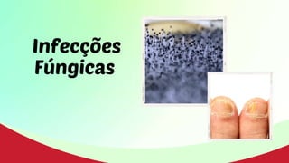 Infecções
Fúngicas
 
