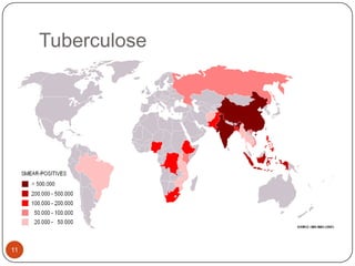Tuberculose




11
 