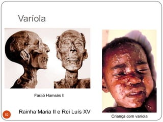 Varíola




           Faraó Hamsés II



52
     Rainha Maria II e Rei Luís XV
                                     Criança com varíola
 