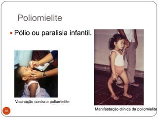 Poliomielite
      Pólio ou paralisia infantil.




       Vacinação contra a poliomielite

55                                       Manifestação clínica da poliomielite
 