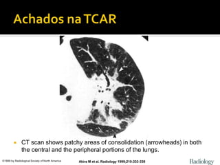      CT scan shows patchy areas of consolidation (arrowheads) in both
              the central and the peripheral portions of the lungs.
©1999 by Radiological Society of North America   Akira M et al. Radiology 1999;210:333-338
 