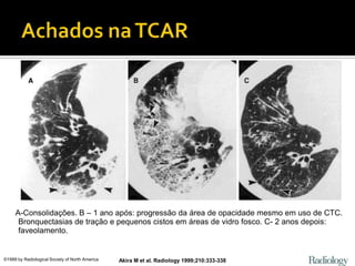 A-Consolidações. B – 1 ano após: progressão da área de opacidade mesmo em uso de CTC.
      Bronquectasias de tração e pequenos cistos em áreas de vidro fosco. C- 2 anos depois:
      faveolamento.


©1999 by Radiological Society of North America   Akira M et al. Radiology 1999;210:333-338
 