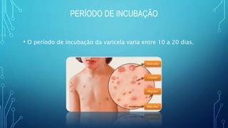 PERÍODO DE INCUBAÇÃO
• O período de incubação da varicela varia entre 10 a 20 dias.
 