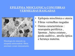 EPILEPSIA MIOCLONICA COM FIBRAS VERMELHAS RASGADAS Epilepsia mioclônica e ataxia Fibras vermelhas rasgadas Outras características : neuropatia periférica , lipomas , baixa estatura , perda auditiva , atrofia óptica e herança materna. Histologia do músculo na miopatia mitocondrial: fibras anormais coram intensamente. 